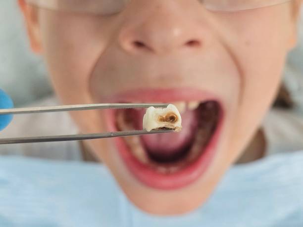 Best Broken or Cracked Tooth Emergency Dentist in Armona, CA